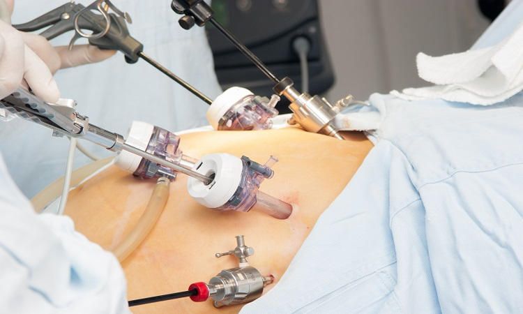 Gynaecology Surgeries